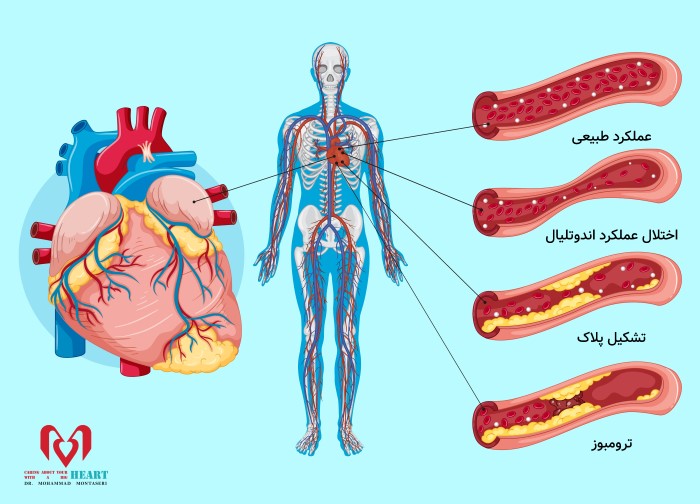 گرفتگی رگ بعد از آنژیوپلاستی